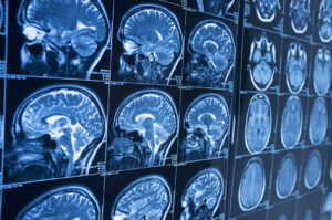 How Santana & Blanchard Personal Injury Lawyers Can Help After a Brain Injury in Gretna, LA